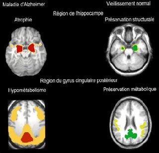 Un mode de vie équilibré est essentiel. Les zones du cerveau préservées lors du vieillissement ...