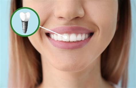 The Benefits Of Mini Dental Implants Desert Dental