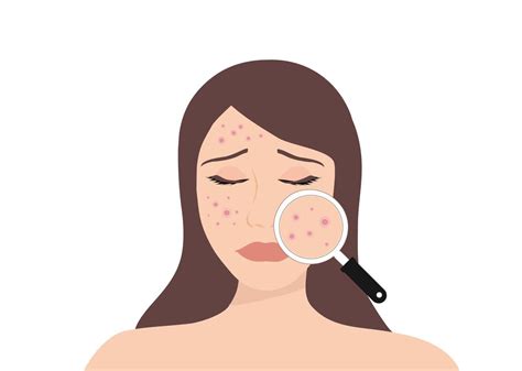 Young Woman Face With Skin Acne Pimples Blackheads Vector