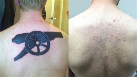 Laser Tattoo Removal Does Laser Tattoo Removal Hurt Youtube