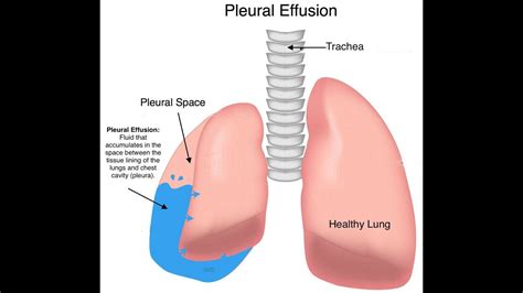 Pleural Effusion Anatomy Clinical Youtube
