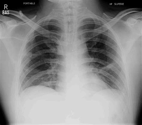 Normal Chest X Ray On The 1 St Postoperative Day In Intensive Care Unit