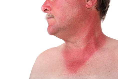 Why The Sun Damages Your Skin