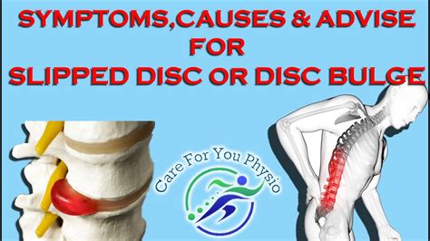 Check spelling or type a new query. Everything You Should Know About Slipped Disc or Disc ...