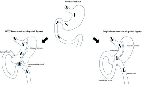 Surgical One Anastomosis Gastric Bypass Configuration Versus Notes One