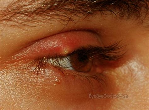 Swollen Eyelid Treatment Causes Pictures Symptoms Remedies