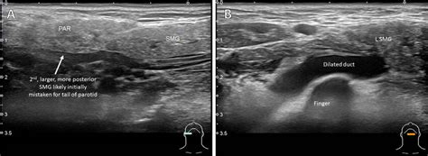 Submandibular Ultrasound A Right Submandibular Gland Which Measures
