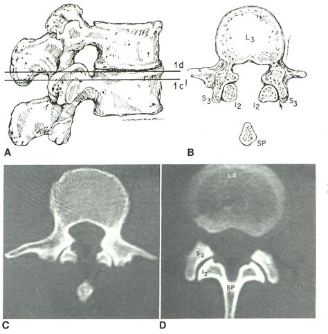 Figure From Thoracolumbar Region CT Patterns Of Facet Fracture Dislocations In The Semantic