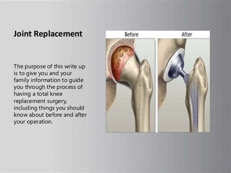 Total Hip Replacement Types