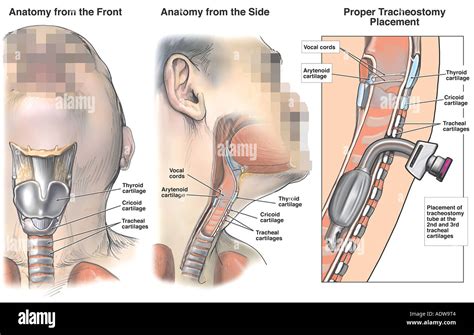 Anatomy Of The Trachea With Proper Tracheostomy Placement Stock Photo
