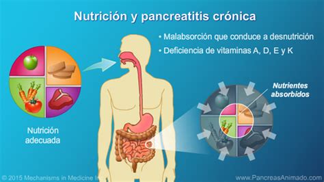 A pancreatite aguda é a inflamação do pâncreas que acontece principalmente devido ao consumo excessivo de bebidas alcoólicas ou à presença de pedras na vesícula. Manejo y tratamiento de la pancreatitis crónica ...