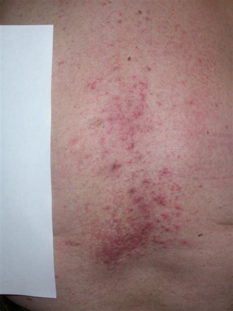 Herpes Zoster Syn Shingles