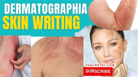 Living With Dermatographia Or Skin Writing Symptoms Diagnosis And