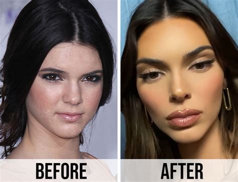 These Before And After Pics Of Kendall Jenner Are Insanewhat Did She Do To Her Lips Shefinds