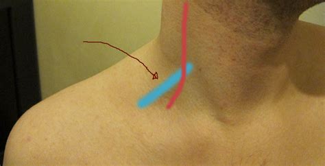 What Exactly Is This Inflamed Area Of My Neck Neurotalk Support Groups