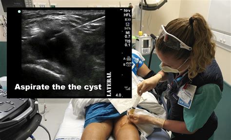 Bakers Cyst — Highland Em Ultrasound Fueled Pain Management