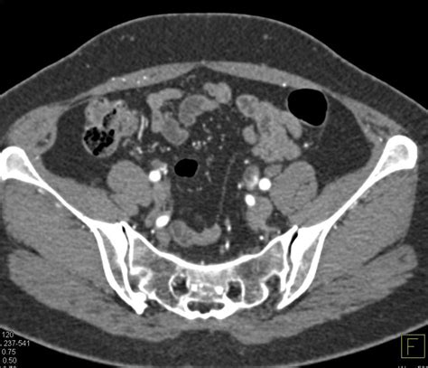 Transitional Cell Cancer Tcc Left Distal Ureter Genitourinary Case