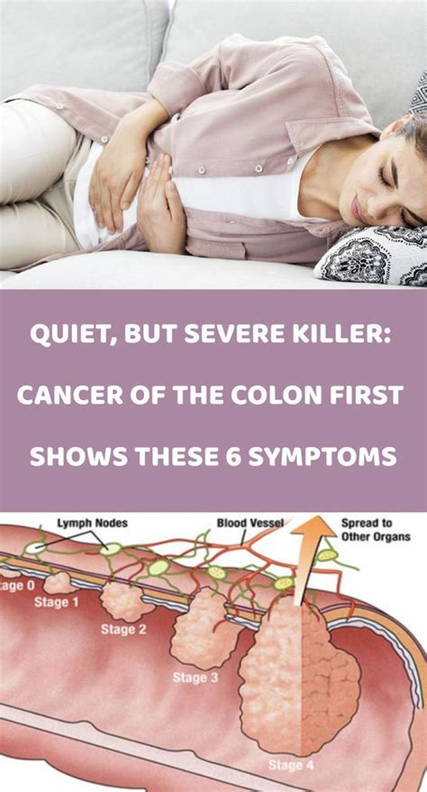 Symptoms For Colon Cancer Stage 1 Symptoms Of Disease