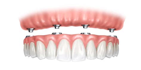 Tipos de prótesis dentales Clínica Dental Balú