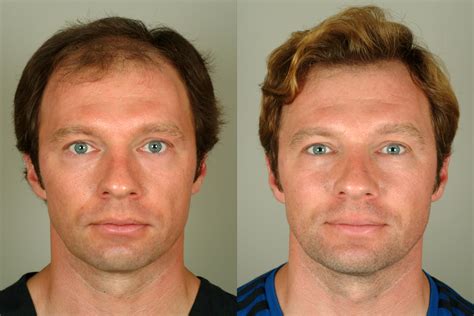 Clevaland Hair Transplants Before And After Dr Haber