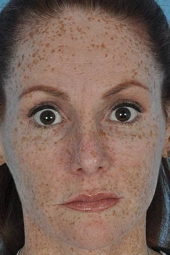 Dark Brown Spots On Face