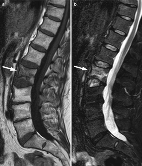 MRI of the Abnormal Bone Marrow: Focal Pattern | Radiology Key