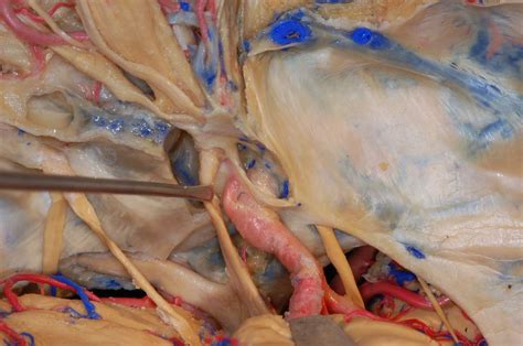 Anatomical variations of the internal carotid arteries and its clinical implications. Superior View of Right Intradural Internal Carotid Artery ...