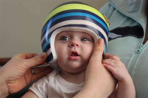Whats The Best Treatment For Positional Plagiocephaly In Infants