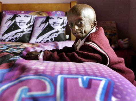 Progeria First Black Child With Rare Aging Disease Photo 12