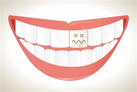 This is similar to a crown you may get after a root canal, but it is designed for cosmetic purposes. Natural White - Tooth Whitening & Veneers In Reading