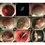 Submucosal Tunneling Endoscopic Resection An Effective And Safe 