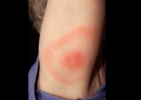 Brown Recluse Bite Pictures Stages Signs And Treatment Youmemindbody