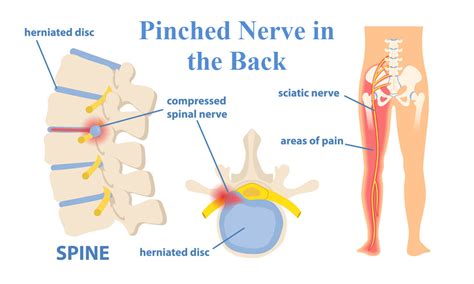 Pinched Nerve Of The Back Joi Jacksonville Orthopaedic Institute