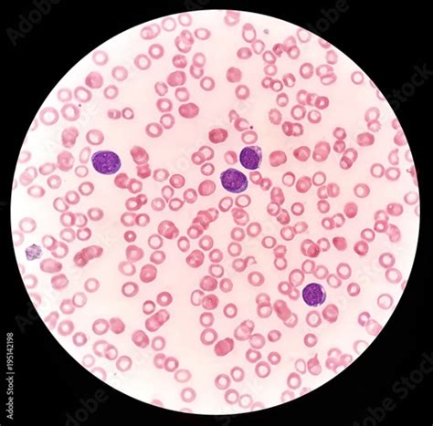 Human Blood Smear Under 100x Light Microscope With Blast Cells And