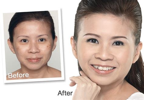 Eye Rejuvenation Treatment In Singapore Dark Eye Circle Wrinkles And More