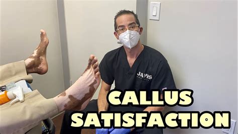 Extensive Removal Of Huge Plantar Calluses Youtube