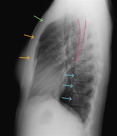 Casestacks Chest X Ray Anatomy For Medical Students