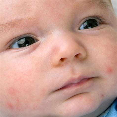 How To Treat Baby Acne Baby Rash Baby Food Allergies Baby Acne