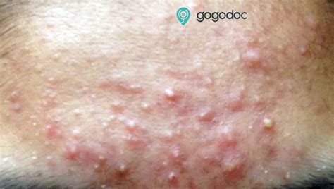 Folliculitis Genital Area