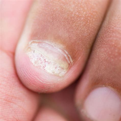 Liquen Plano Nas Unhas