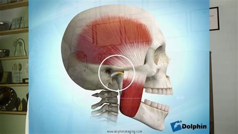 Que es la Articulación Temporomandibular y como se manifiesta YouTube