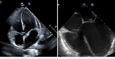 Tte And Tee Showing Mitral And Tricuspid Valve Vegetations The