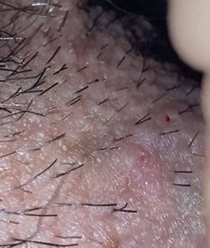 It is easy to tell genital warts apart from herpes or ingrown hair bumps. Is this herpes ??? Help pics included | Genital Herpes ...