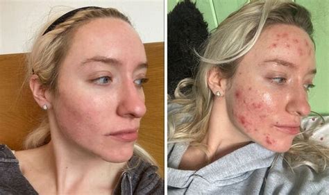 Woman Shares Skin Transformation After Feeling Ugly I Love Myself Now Uk