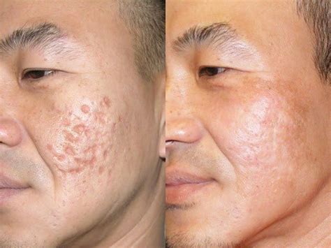 Guide To Acne Scar Removal In Singapore 2022 By Dr Isaac Wong