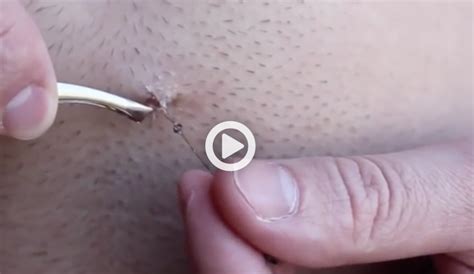 Gently exfoliate to remove dead cells. Longest Ingrown Hair Removal EVER - Medical Videos
