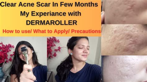 Dermaroller DIY Treat Acne Scar Open Pores Pigmentation