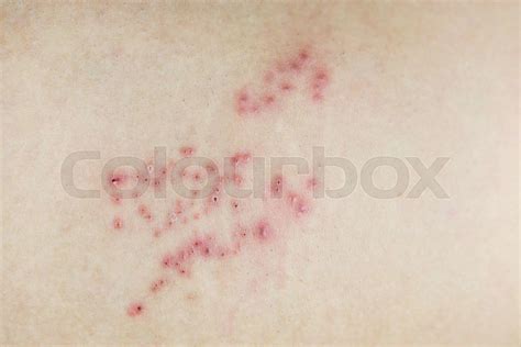 Raised Red Bumps And Blisters On Skin Stock Image Colourbox