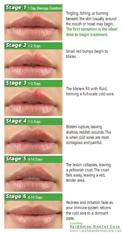 17 Images About Cold Sores On Pinterest First Aid Cold Sore And