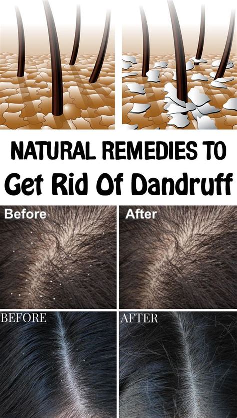Natural Remedies To Get Rid Of Dandruff Healthy Crown